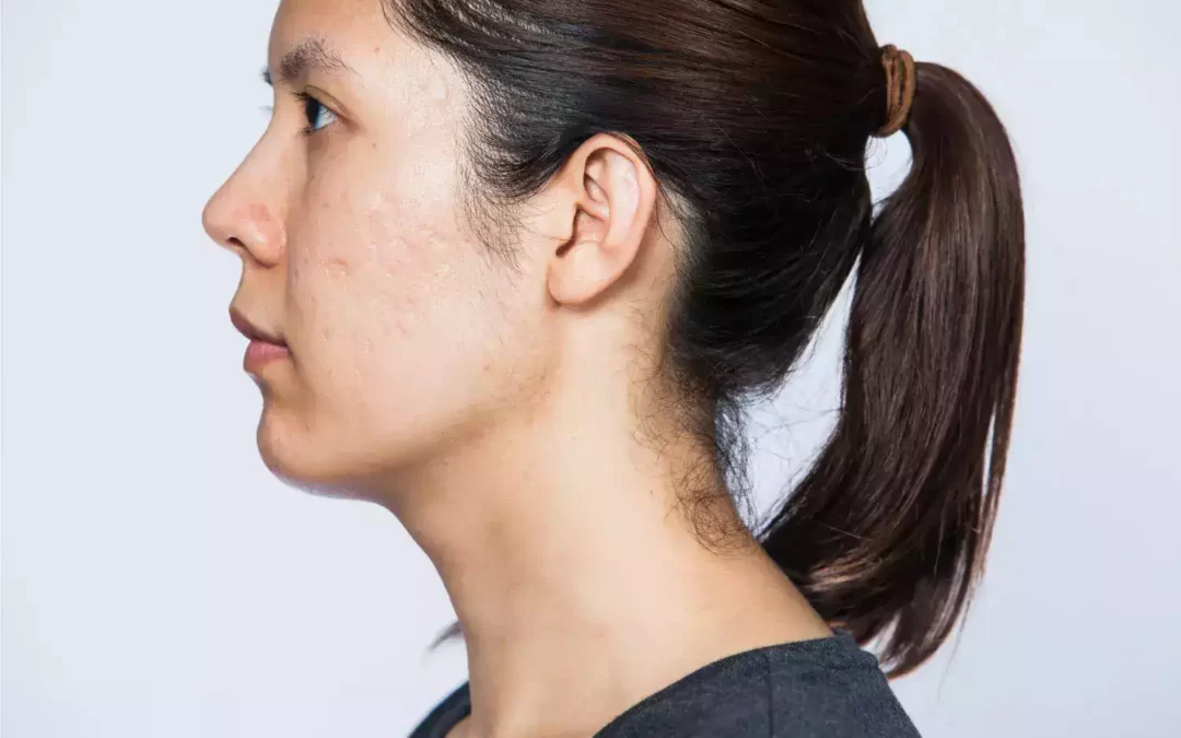 Facing Acne How Specifically To Cope Using its Effects