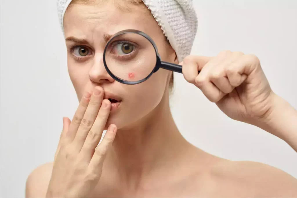 natural acne treatments 1