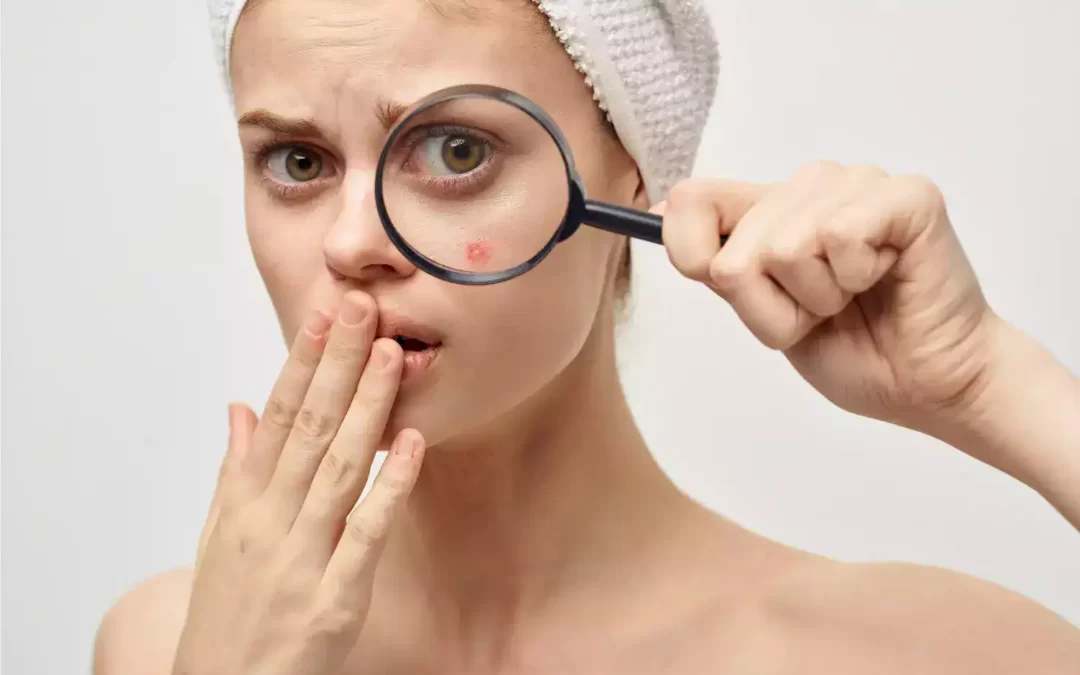 Others Natural Acne Treatments