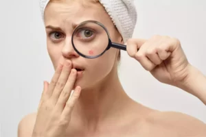 natural acne treatments 1