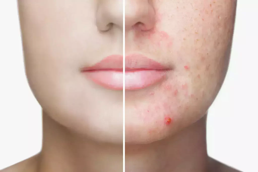 natural acne treatments 2