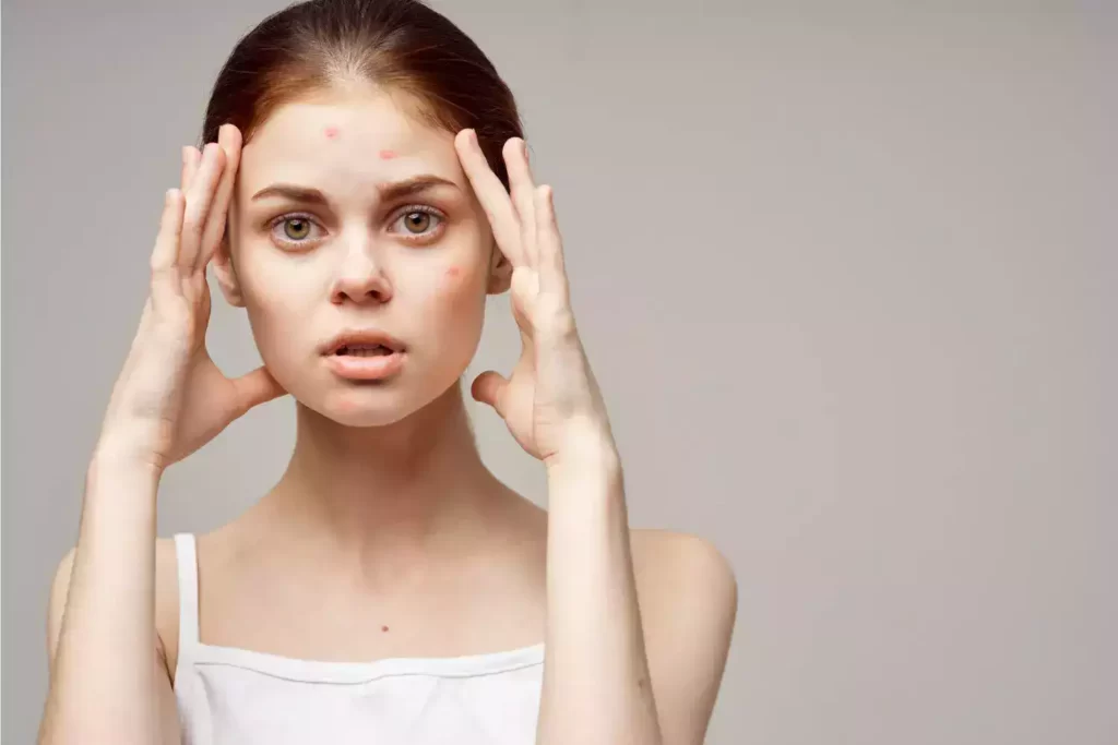 natural acne treatments 4