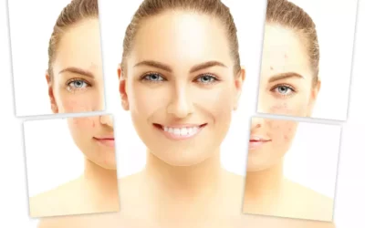 The Best Treatment for Rosacea Face