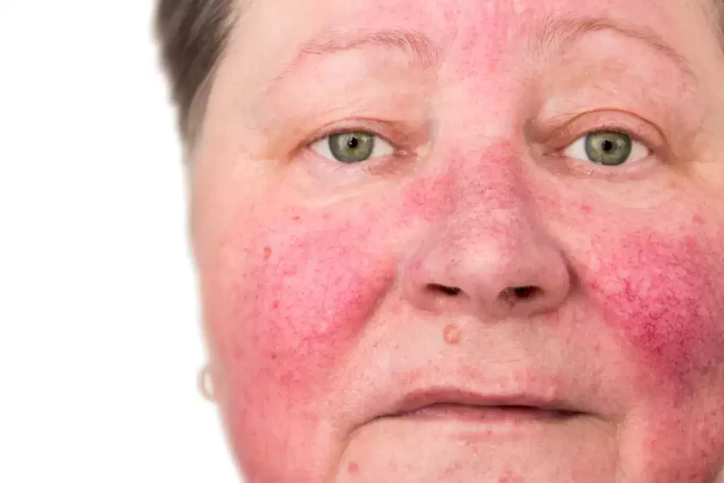 rosacea face 4 