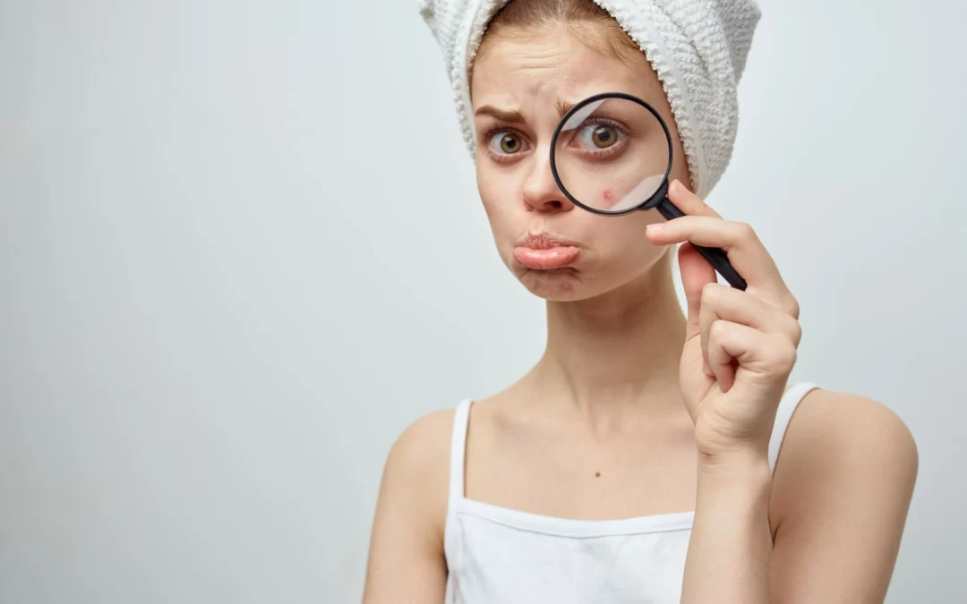 Emotional Stress and Acne